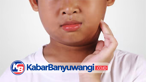 Ratusan Anak di Banyuwangi Terjangkit Mumps, Dinkes Imbau Sekolah dan Orang Tua Waspada